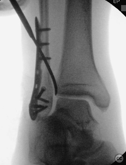 SER ankle injury with occult PITFL + deltoid instability