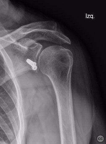 Anterior Shoulder Subluxation with Anterior Glena Fracture