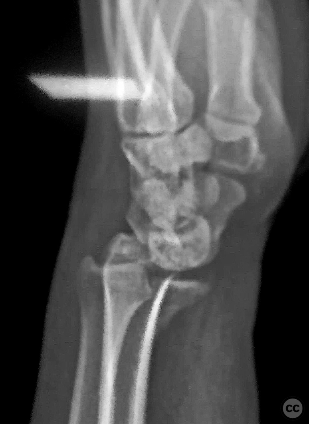 Learningradiology Barton Fracture Dislocation Radius Distal My Xxx