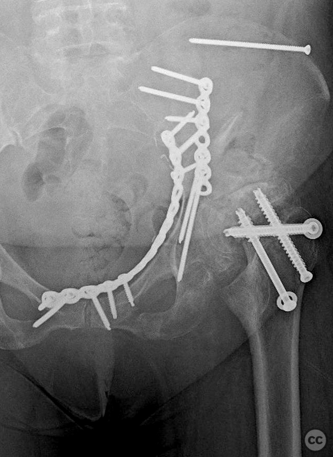 Associated Both Column Acetabular Fracture And A Femoral Neck Fracture ...