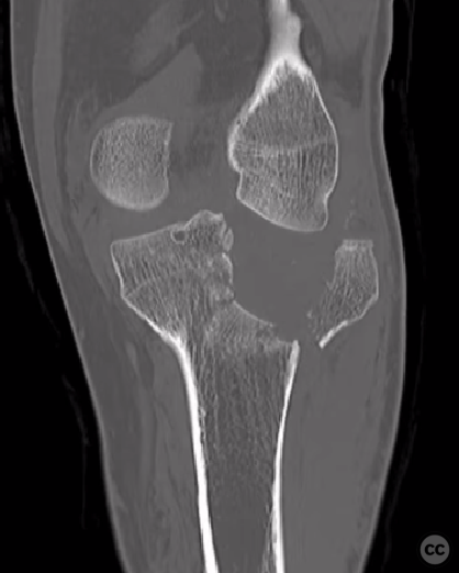 Posterolateral And Posteromedial Approach To The Tibial Plateau ...