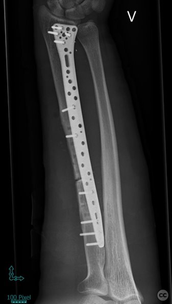 Revista Brasileira de Ortopedia - Treatment of Distal Radio Vicious  Consolidation: Corrective Osteotomy Through 3D Printing  Prototyping<sup>*</sup>