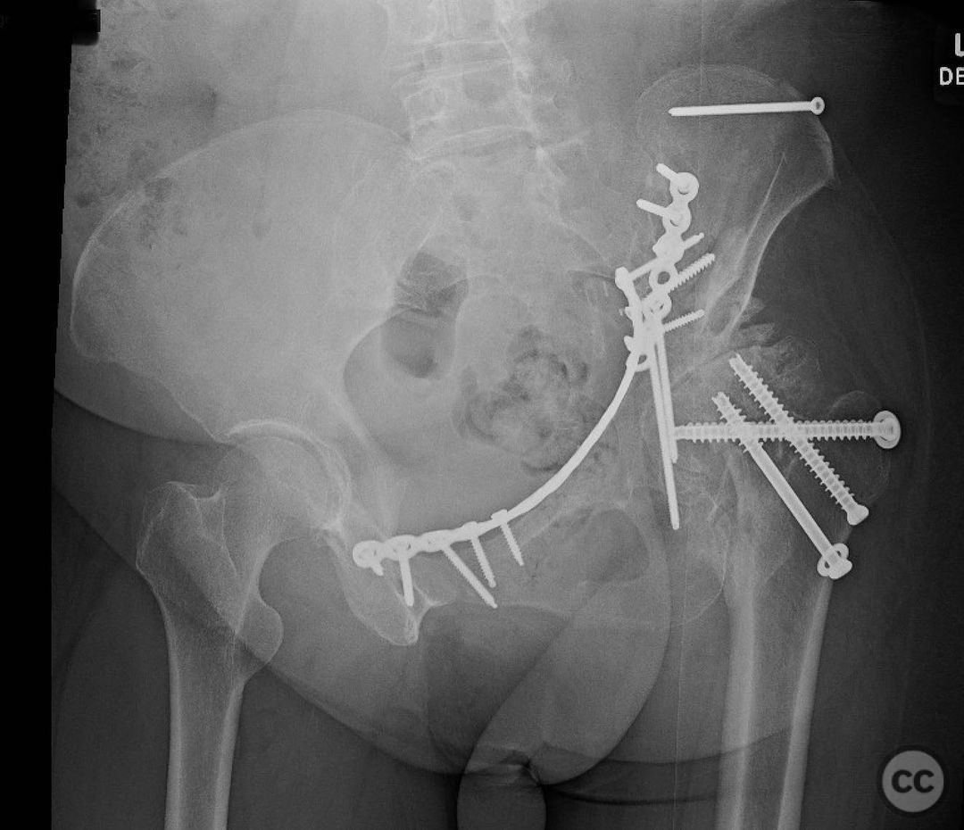 Associated Both Column Acetabular Fracture And A Femoral Neck Fracture With Oa