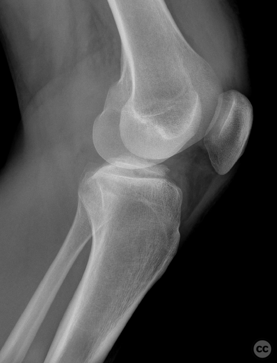 Apple-bite posterolateral corner and ACL / Eminentia Avulsion