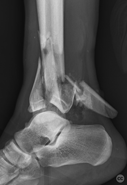 Bilateral 43C3 Pilon Fractures with Right Grade 3A Open Fracture