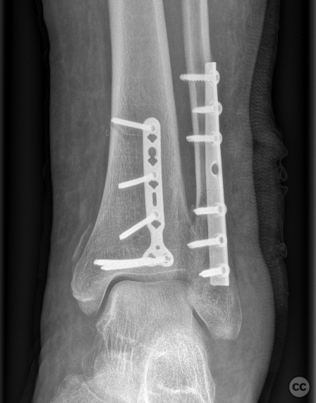 Mason type IIA posterior malleolus fracture