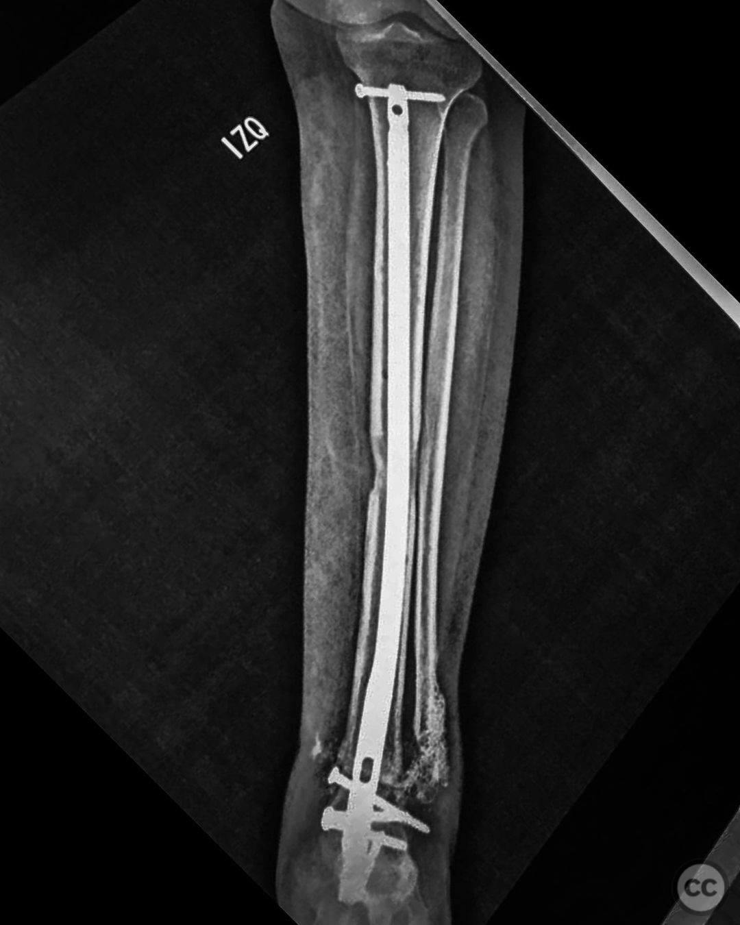 Staged Management Of Osteomyelitis Following Open Tibial Pilon Fracture