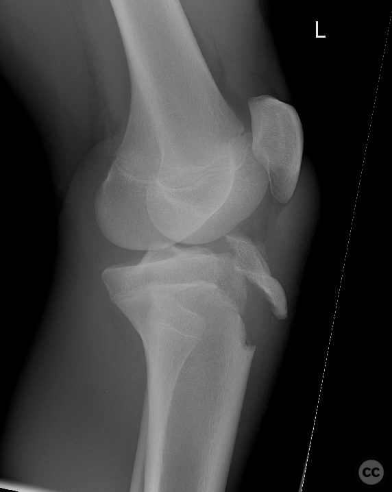 Tibial tubercle fracture - Type III