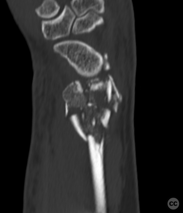 High energy C3 distal radius with metaphyseal defect