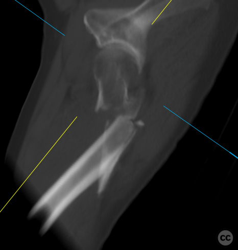 Hardware Failure of Primary Gamma Nail Osteosynthesis in ...