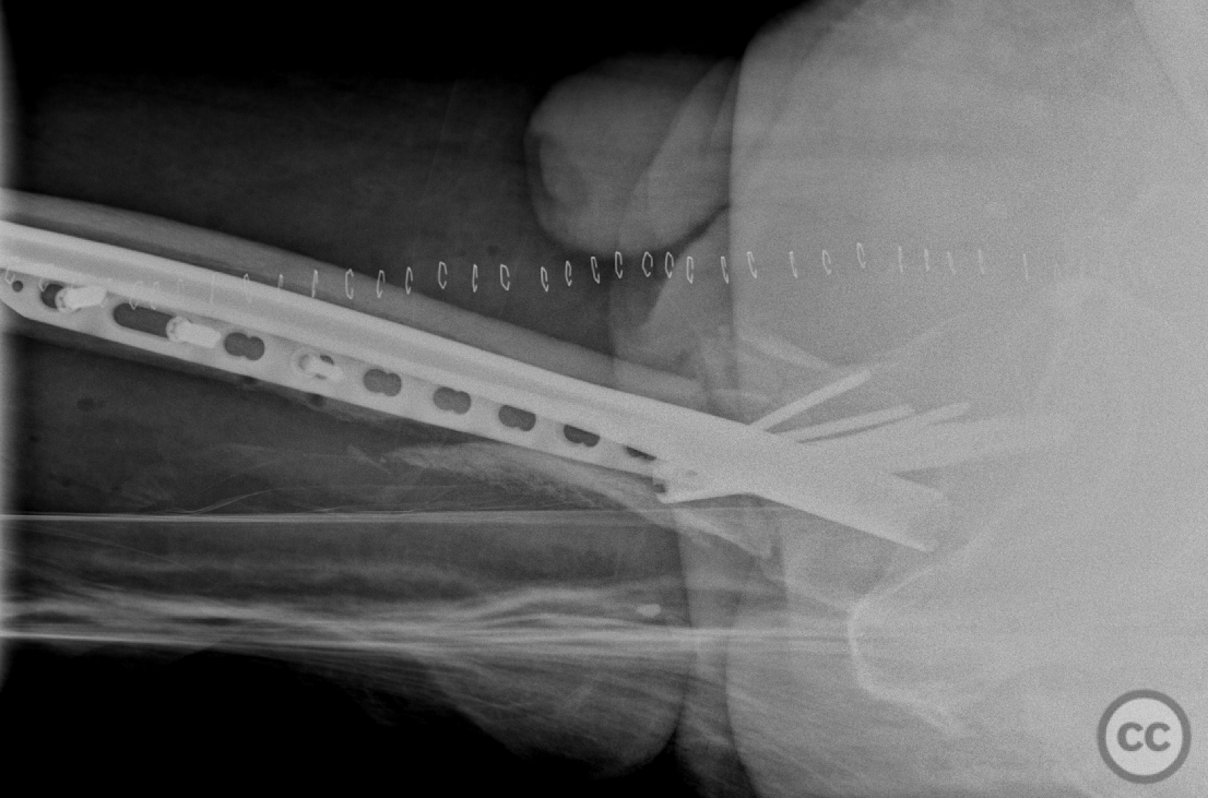 Hardware Failure of Primary Gamma Nail Osteosynthesis in ...