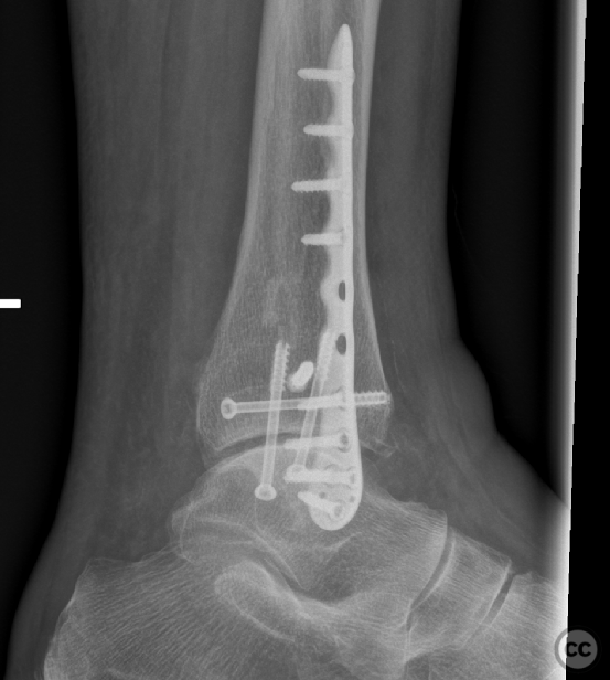 Pronation Abduction (PAb) ankle fracture with Mason 2A lateral plafond ...