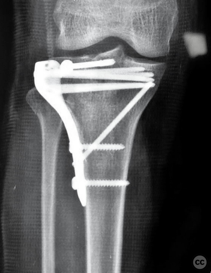 Comminuted lateral tibial plateau fracture