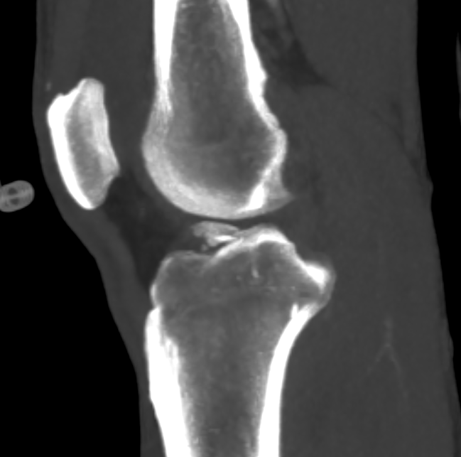 Tibial bony ACL avulsion - open screw osteosynthesis