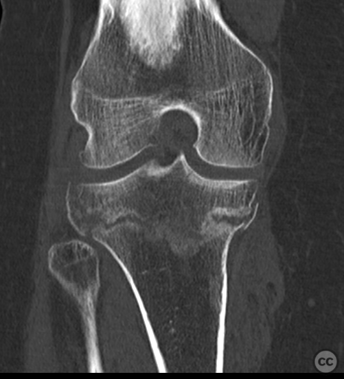 Varus hyperextension tibial plateau fracture