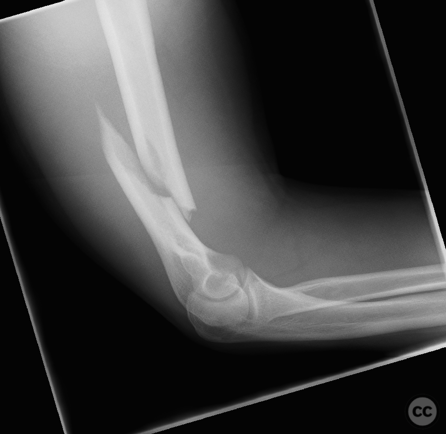 Distal 1/3 humerus shaft fracture - a lateral paratricipital approach with  proximal split window