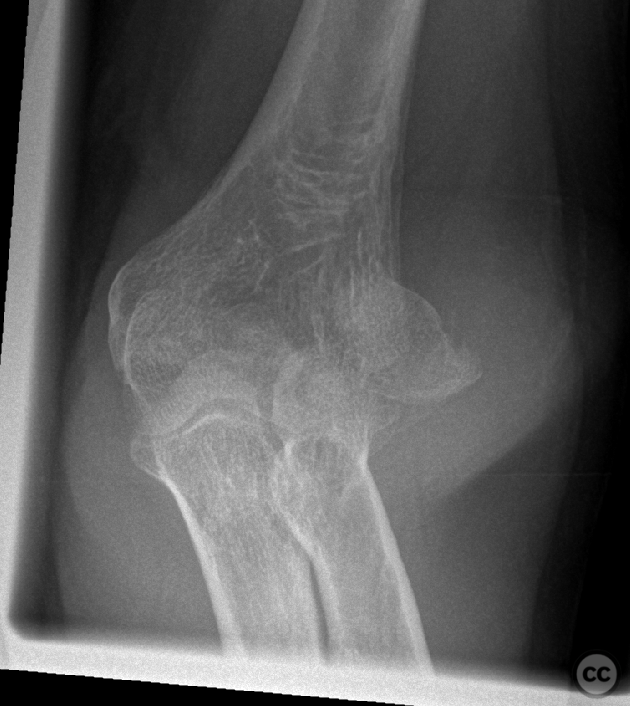 Dubberly 3/4 shear plus comminuted trans condylar trochlear fracture ...