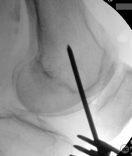 Retrograde SCN plus Poller screw for a distal 1/3 femoral diaphyseal ...