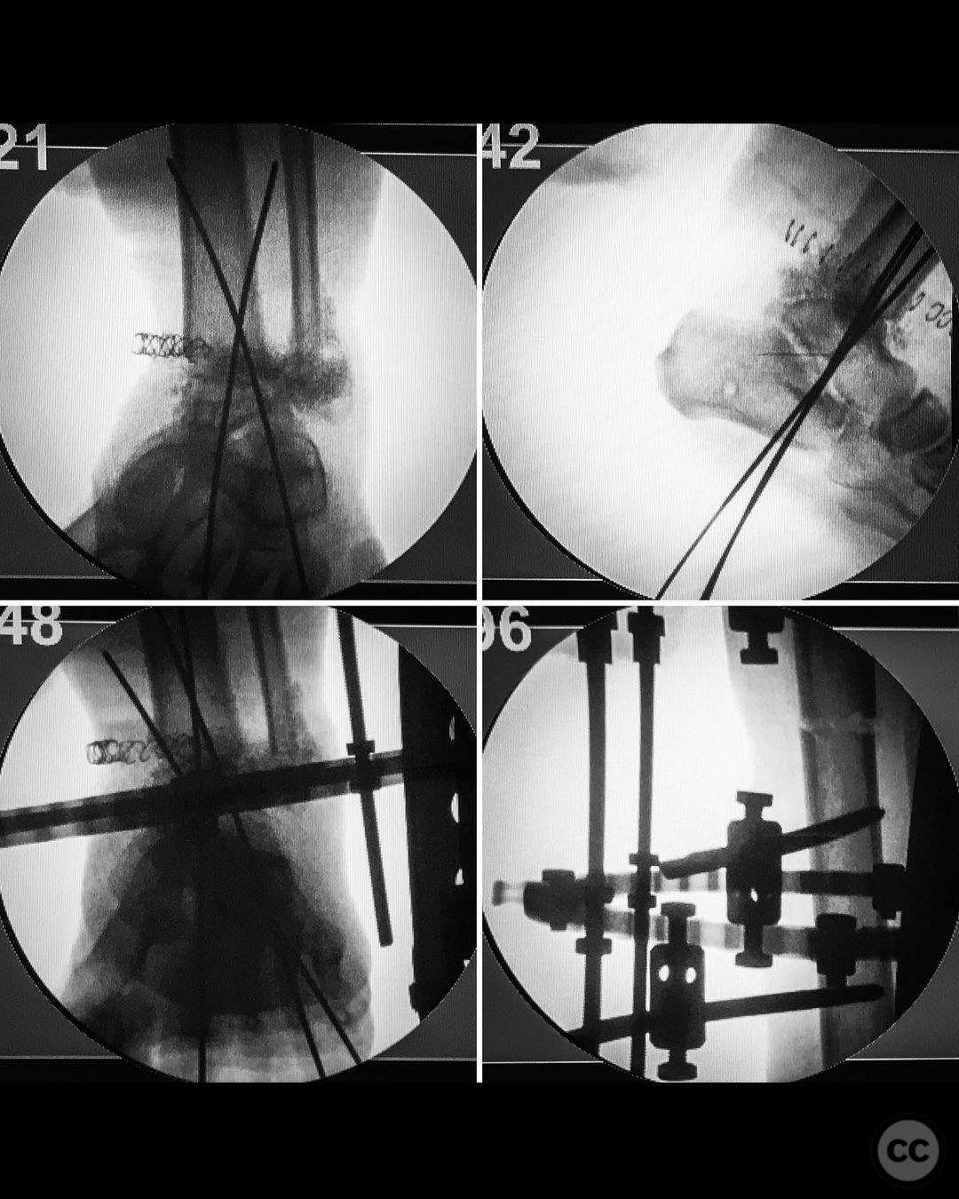 Staged Management Of Osteomyelitis Following Open Tibial Pilon Fracture