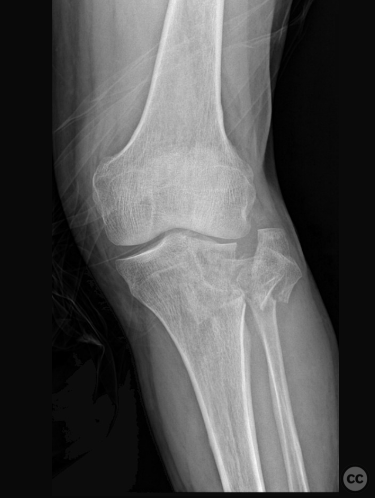 Posterolateral And Posteromedial Approach To The Tibial Plateau ...