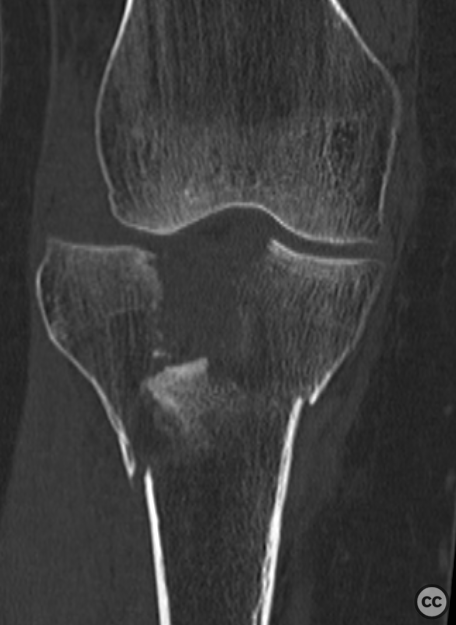 Schatzker VI tibial plateau fracture with ACL and meniscocapsular injury