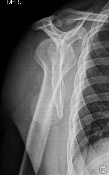 Osteosynthesis of Valgus Proximal Humerus Fracture Impacted in Three ...