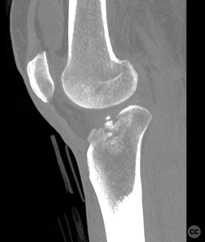 Moore-Like Schatzker 2 lateral tibial plateau fracture