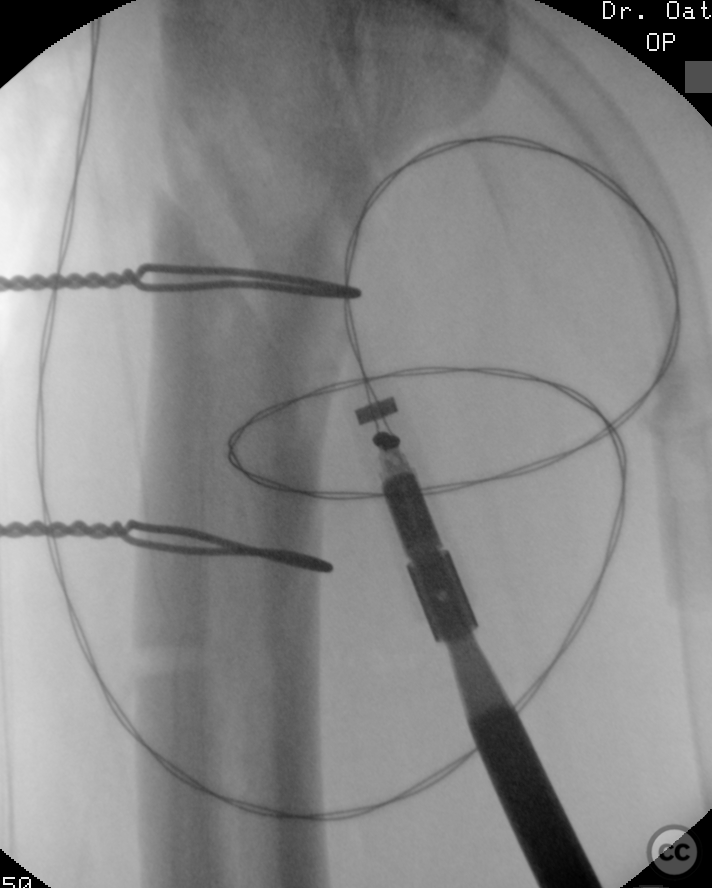 Closed Segmental Comminuted Femoral Fracture