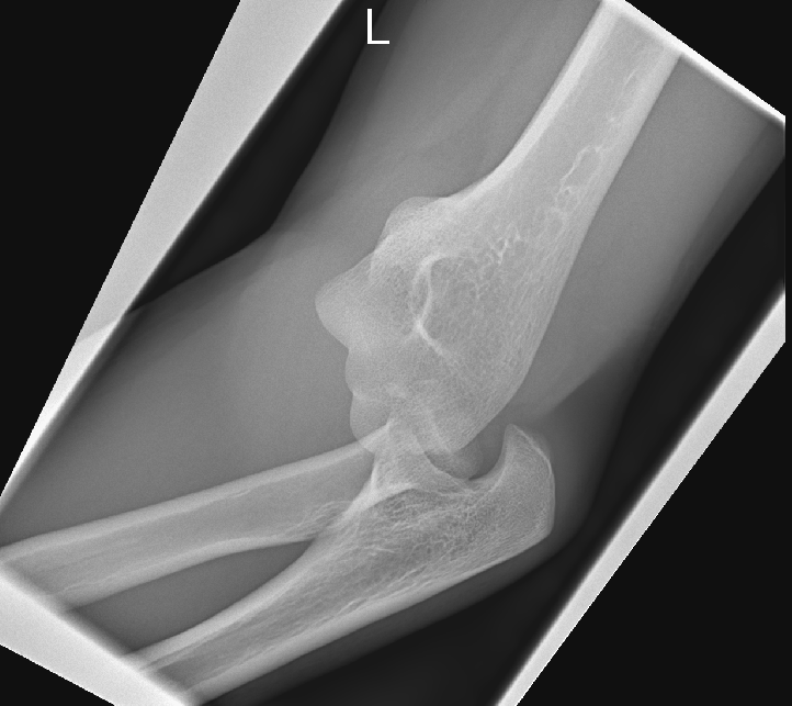 Multidirectional instability following posteromedial elbow dislocation