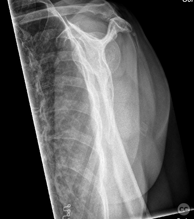 Anterolateral Helix plate - segmental proximal humerus fracture