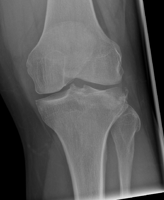 Posterolateral rim-plate Schatzker 2 tibial plateau