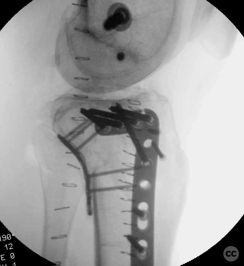 Posterolateral approach to the tibial plateau with femoral epicondylar ...