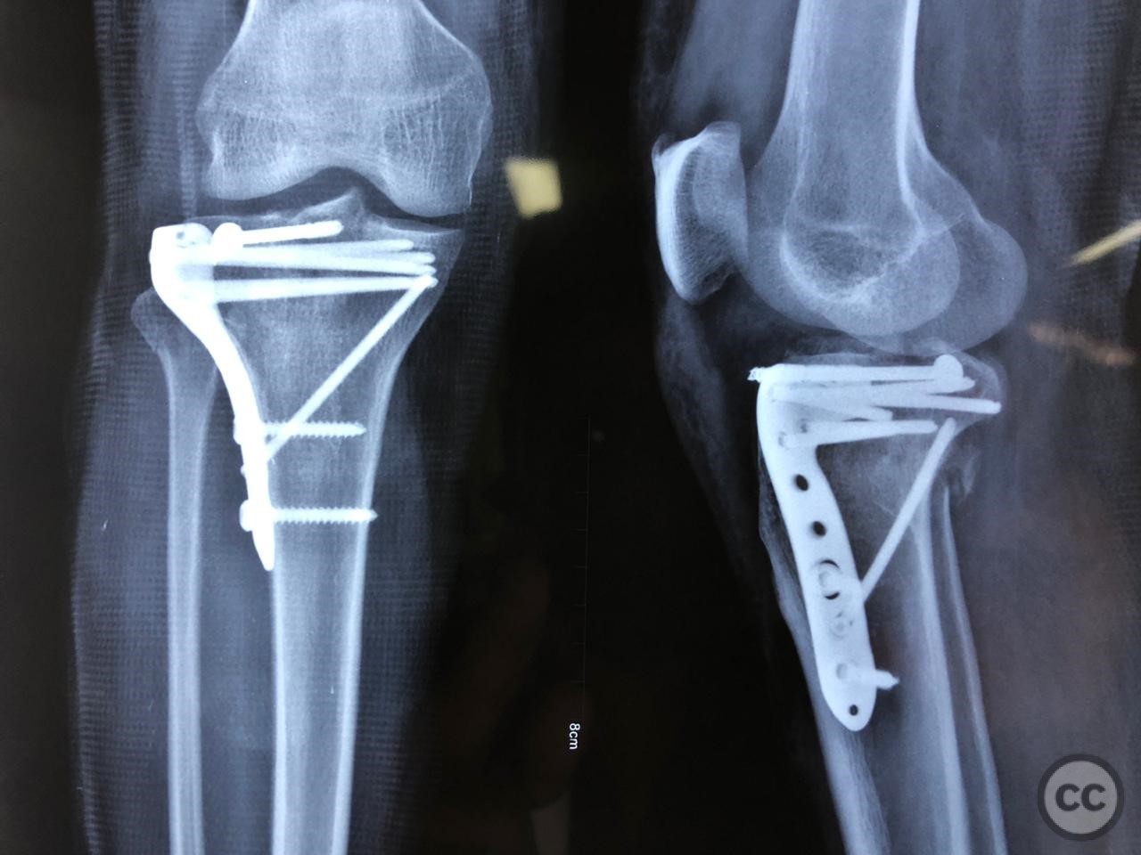 comminuted-lateral-tibial-plateau-fracture