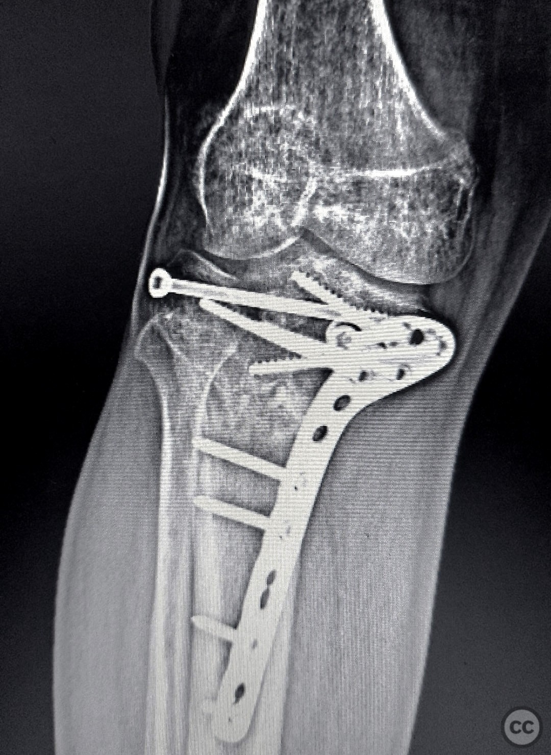 Schatzker Vi Tibial Plateau Fracture