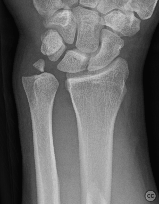 Revision of Galeazzi Fracture Dislocation with TFCC Repair and Ulnar ...