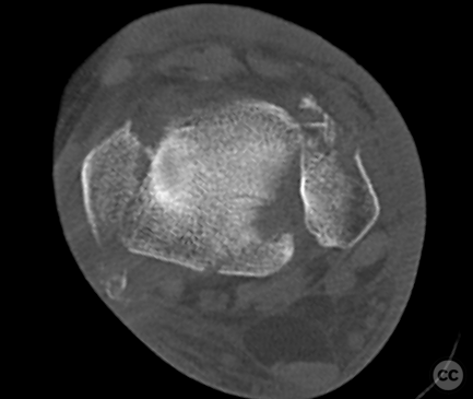 Pronation Abduction (PAb) ankle fracture with Mason 2A lateral plafond ...