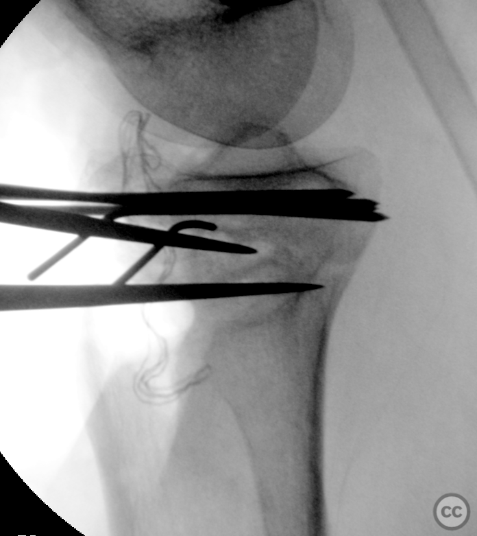 Varus hyperextension tibial plateau fracture