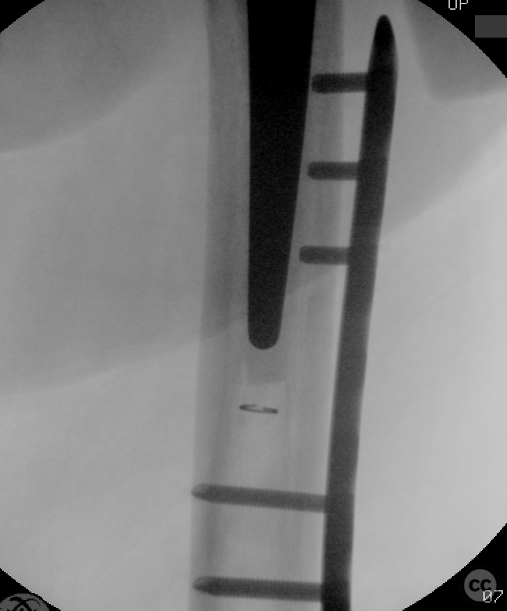 Rorabeck Ii Vancouver C Inter-implant Periprosthetic Femur Fracture