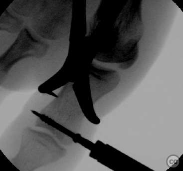 D1 prox phalanx condyle fracture