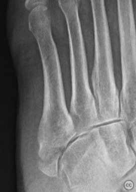 5th Metatarsal Zone 1 Fracture Repair with Dynamic Tension Band