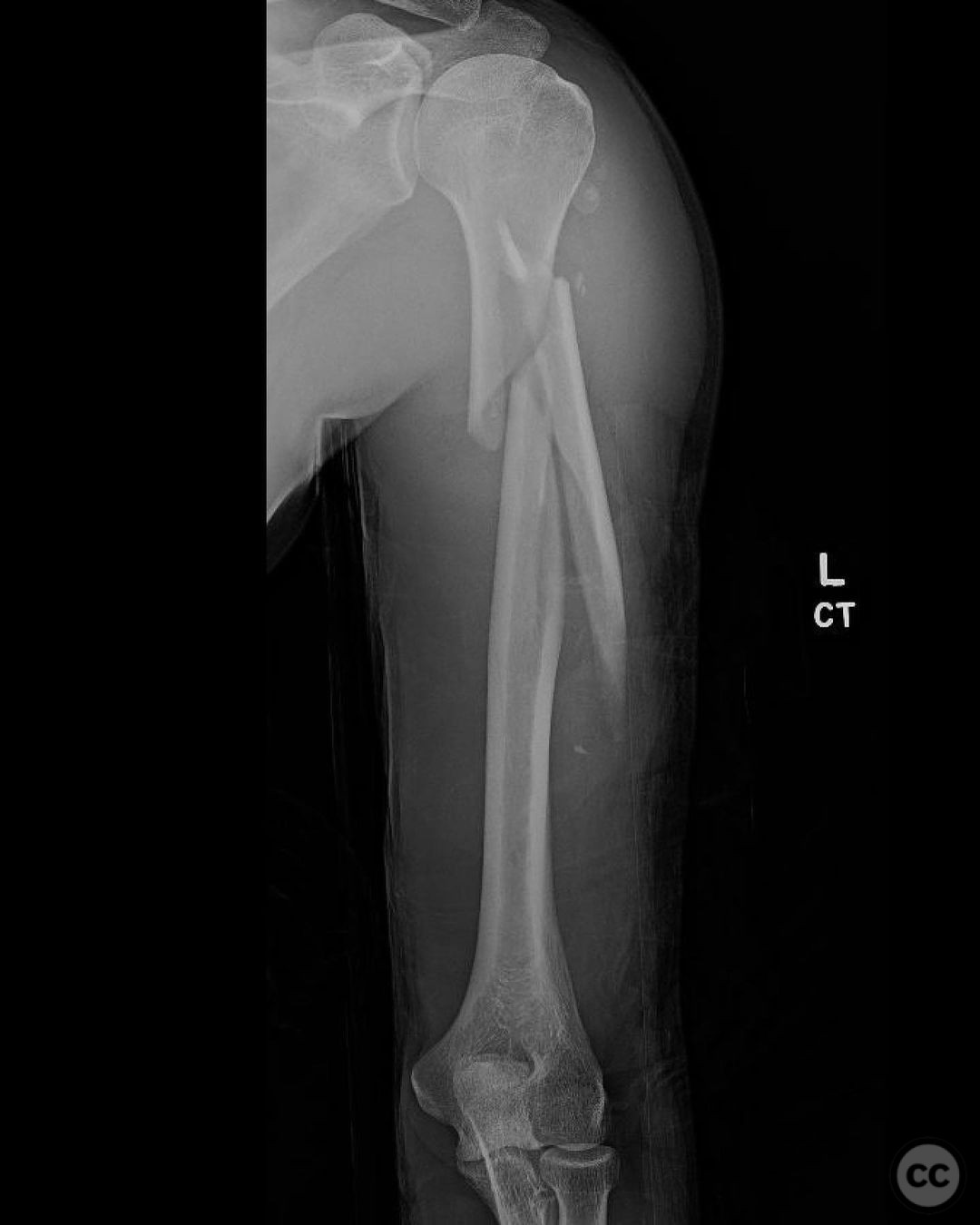 Spiral Proximal Humerus Fracture With Long Butterfly Fragment - IM Nail ...