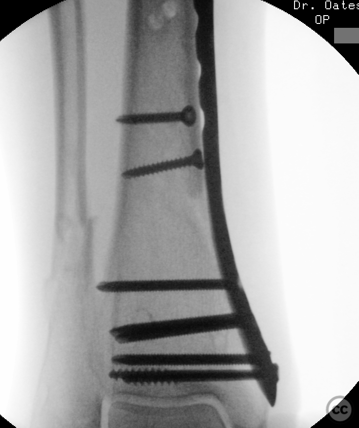 Combined distal 1/3 tibia fracture with SAD bimalleolar ankle fracture