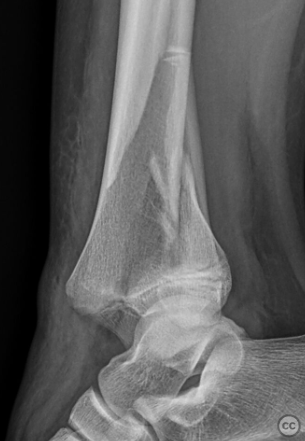 Distal Tibial Salter-Harris IV with Distal Diaphyseal Fibula Fracture