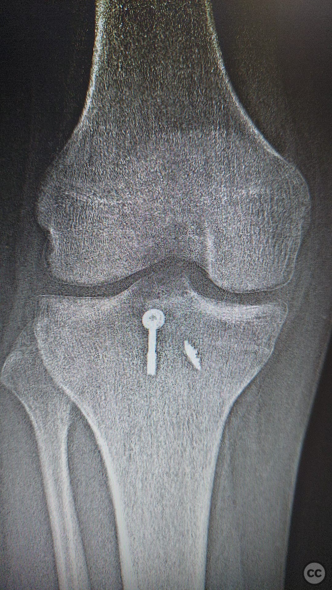 Tibia PCL Avulsion Fracture