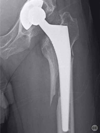 Periprosthetic fracture