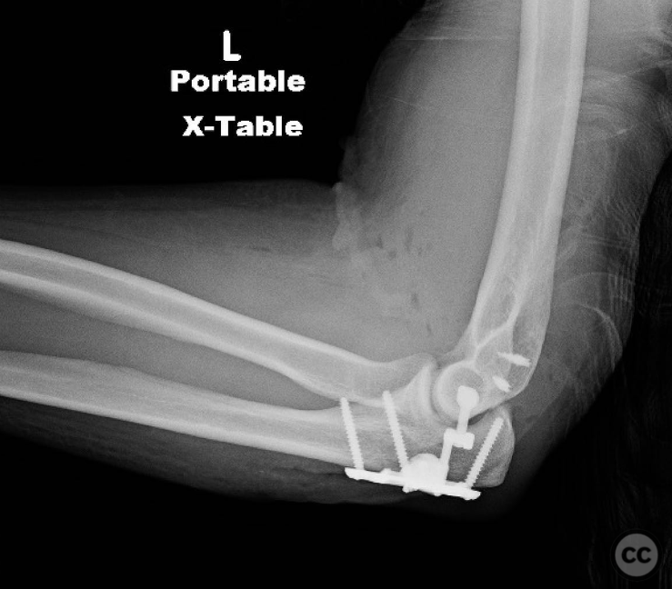 Internal Joint Stabilizer IJS® open posterior elbow dislocation