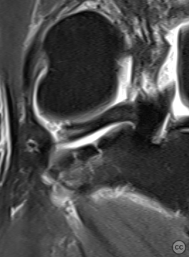 Posterolateral Tibial Plateau Fracture with Meniscal Rupture