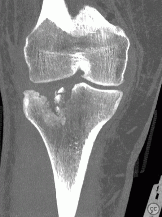 Moore-Like Schatzker 2 lateral tibial plateau fracture