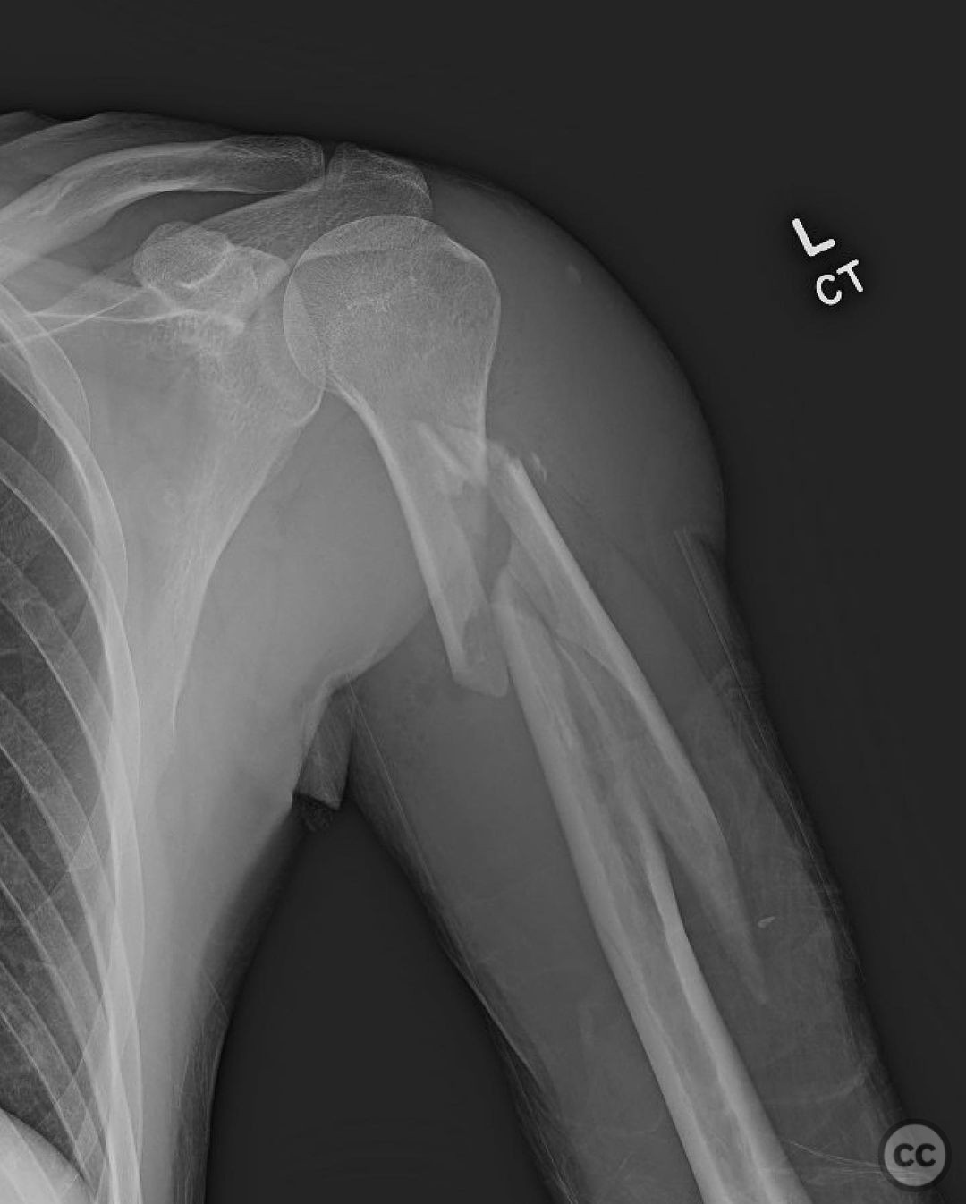 Spiral proximal humerus fracture with long butterfly fragment IM nail