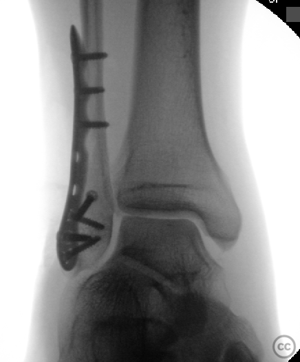 SER ankle injury with occult PITFL + deltoid instability